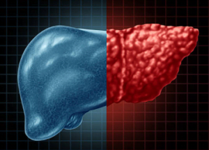 fatty liver